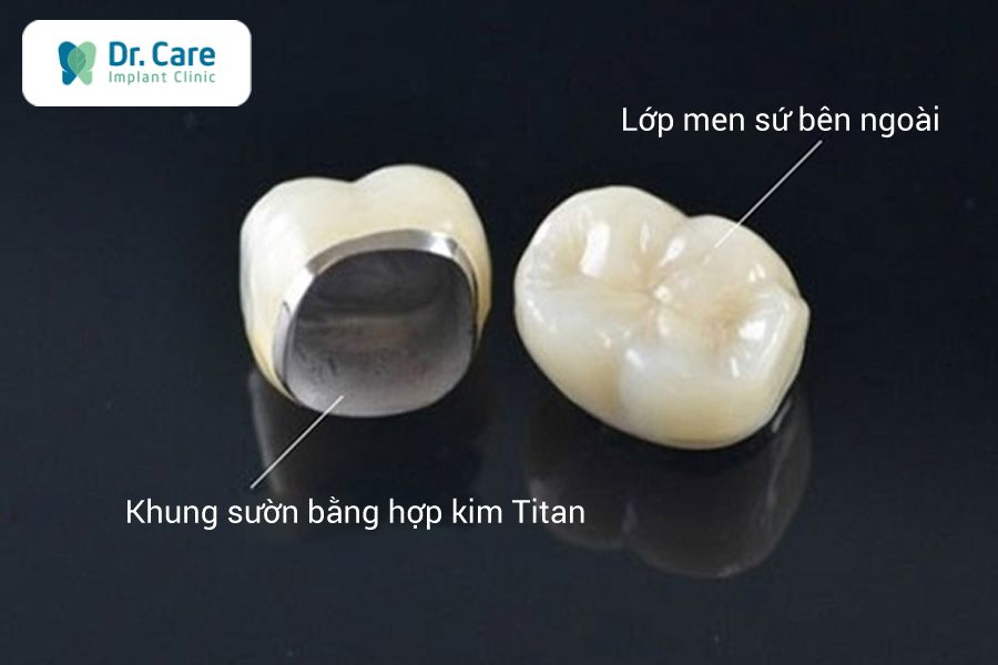 Tìm hiểu về răng sứ Titan