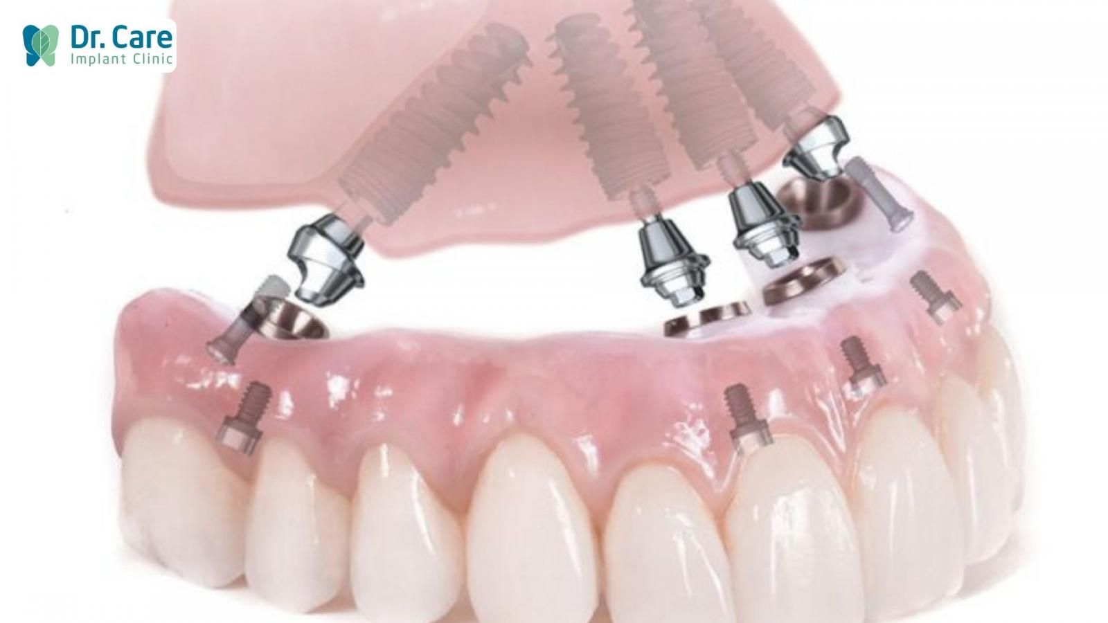 Trồng răng Implant