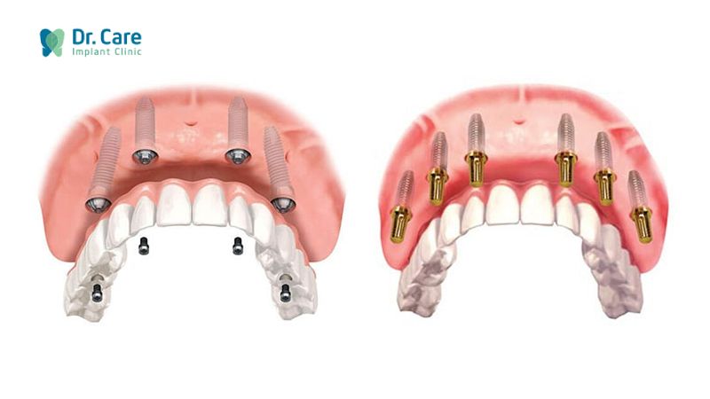 Mất răng nguyên hàm có trồng lại được không?