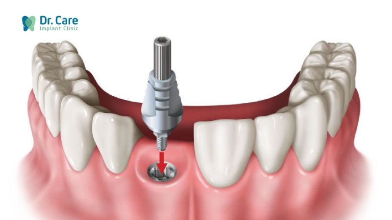 Các phương pháp phục hồi răng đã mất hiệu quả