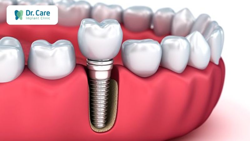 Tại sao mất răng số 6 phải trồng lại ngay?