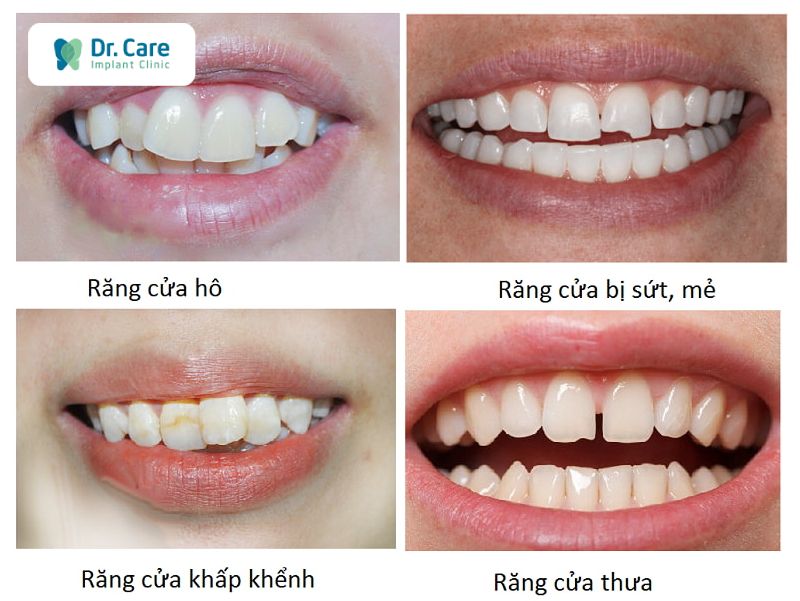 Những trường hợp nào nên bọc răng sứ?