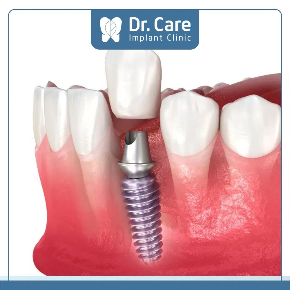 Abutment Implant Tekka Pháp, Abutment Implant Nobel Biocare Mỹ, Abutment Implant Straumann Thụy Sỹ... là những thương hiệu trụ Implant và Abutment tốt nhất hiện nay.