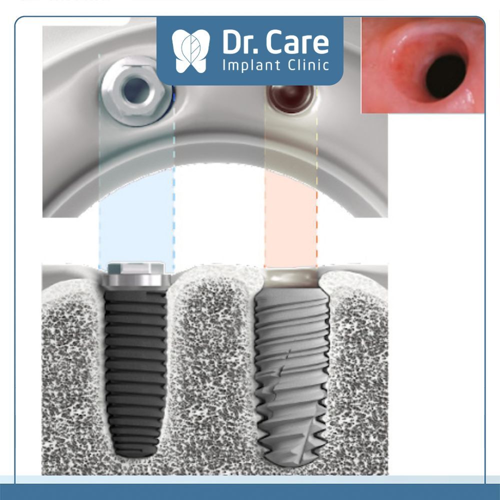 In-Kone®, hệ thống implant đầu tiên của Pháp có kết nối côn thuôn 8 độ, diện tích bề mặt tiếp xúc là 20mm2 đảm bảo được sự khít sát