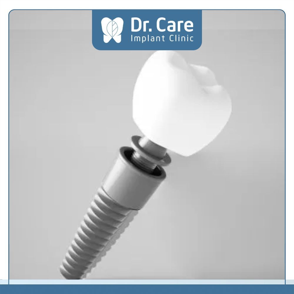 Mất răng lâu năm cần loại trụ Implant có cấu tạo từ Titanium lành tính và độ cải tiến về công nghệ để giúp khắc phục tốt khả năng ăn nhai lẫn thẩm mỹ 