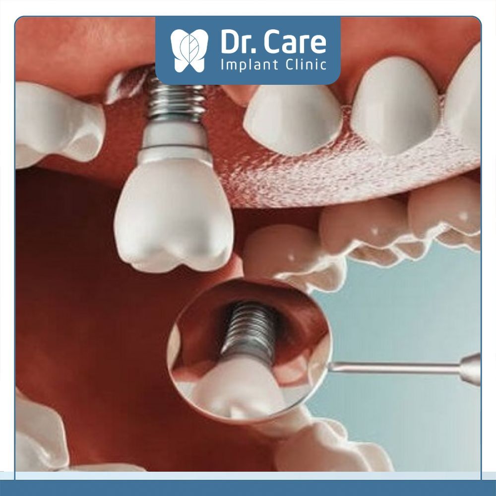 Trụ Implant tốt là trụ được cấu tạo từ Titanium nguyên chất, lành tính từ đó đảm bảo duy trì tuổi thọ cho răng Implant mà không gây kích ứng và biến chứng nguy hiểm