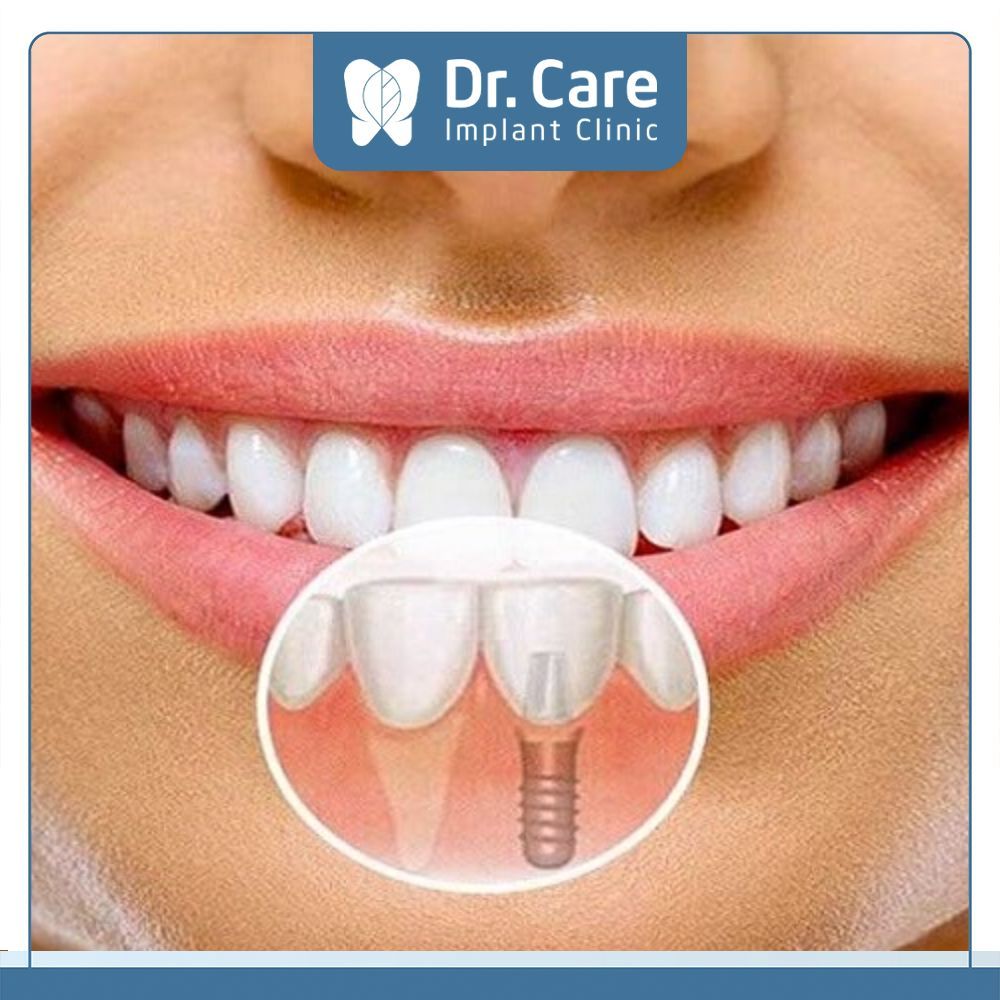 Trụ Implant là thành phần vô cùng quan trọng để quyết định sự thành công của răng Implant. Và sau đây là 4 tiêu chí