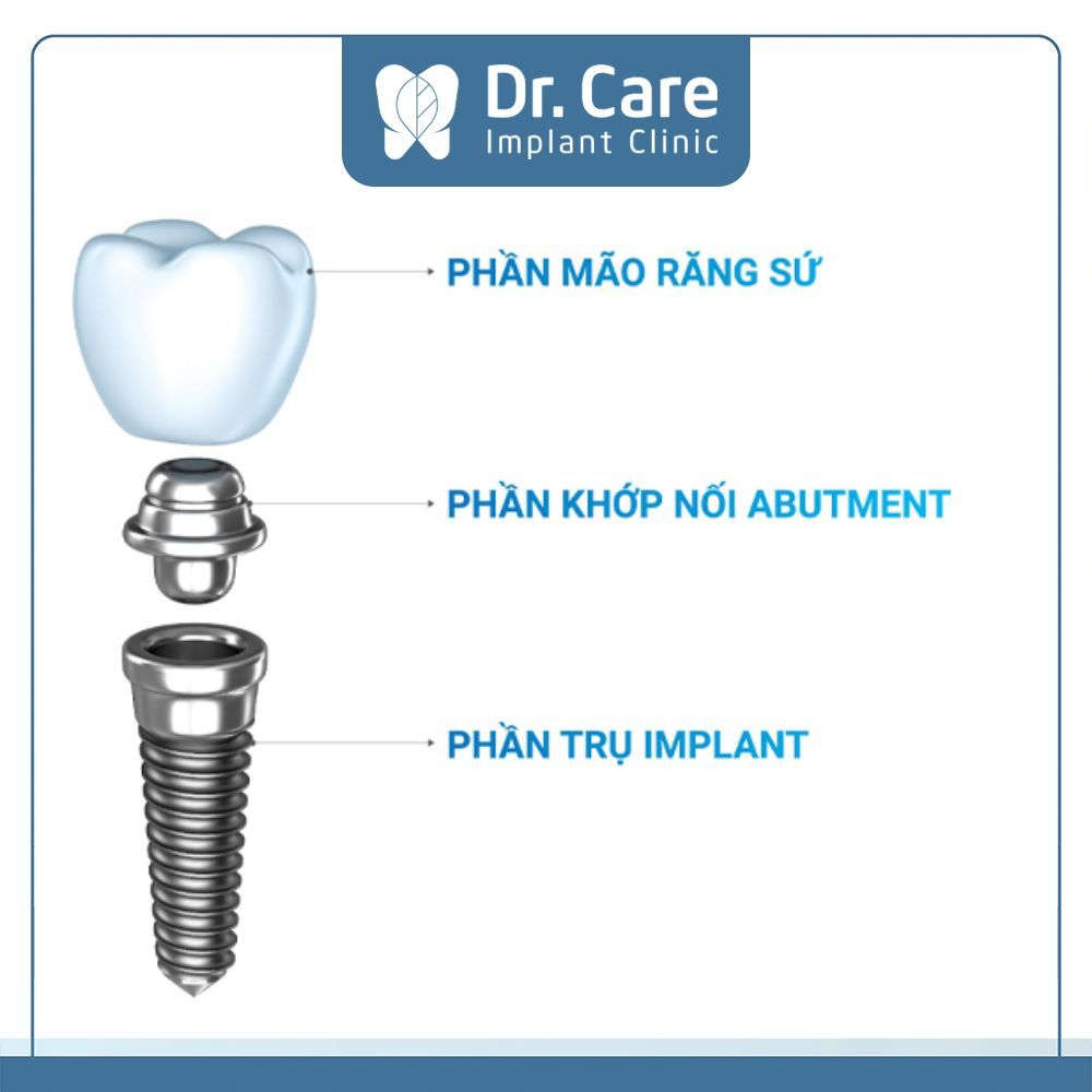 Cấu Implant có 3 phần, bao gồm: trụ Titanium (trụ Implant), Abutment và mão răng sứ