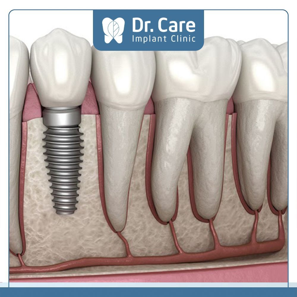 Trụ Implant Đức đem lại kết quả phục hình tốt nhất với điều kiện cấy ghép trên xương hàm đảm bảo chất lượng tốt