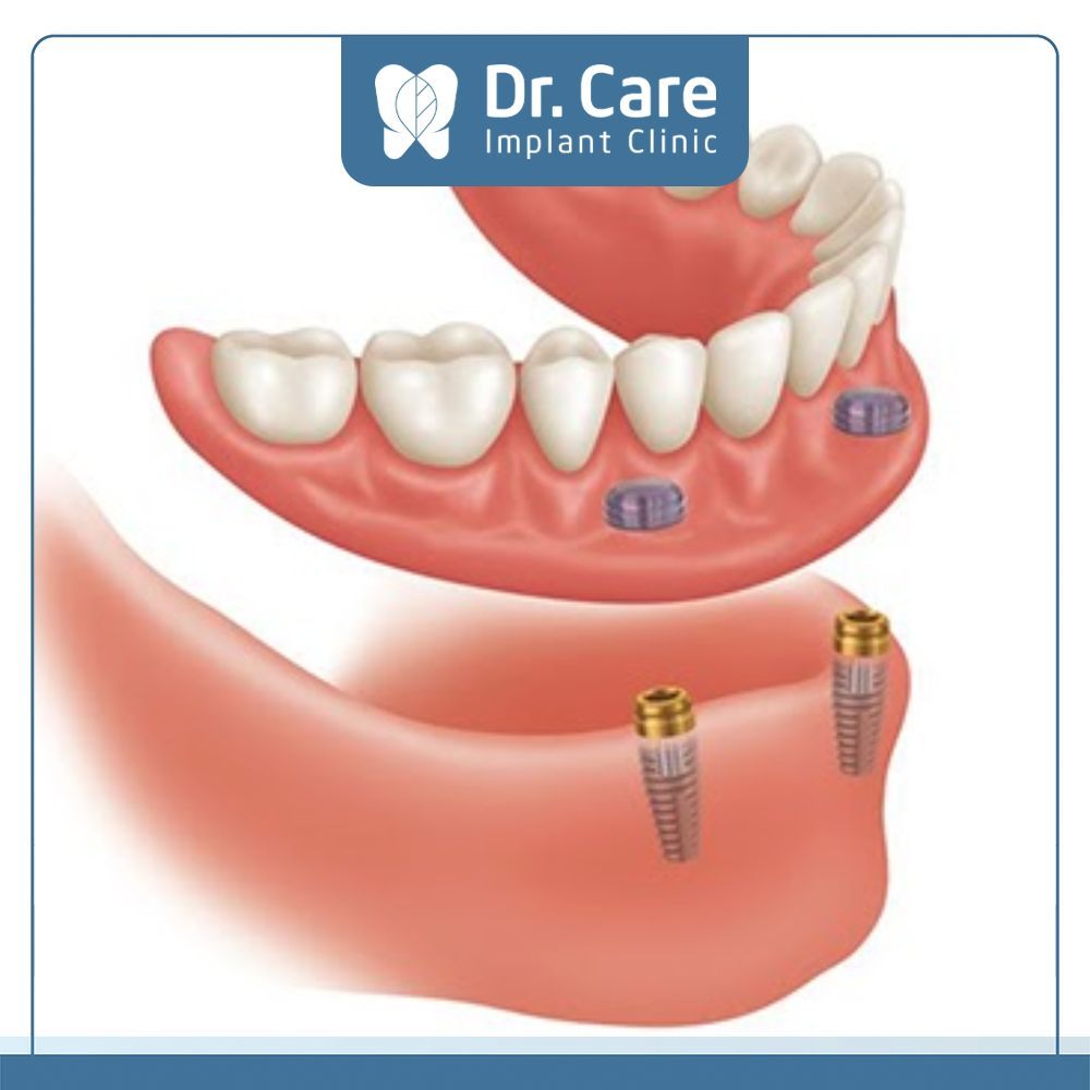 Hàm tháo lắp trên Implant là phương án phục hình mất răng cải tiến, với sự kết hợp giữa hàm giả tháo lắp cổ điển và cấy ghép Implant