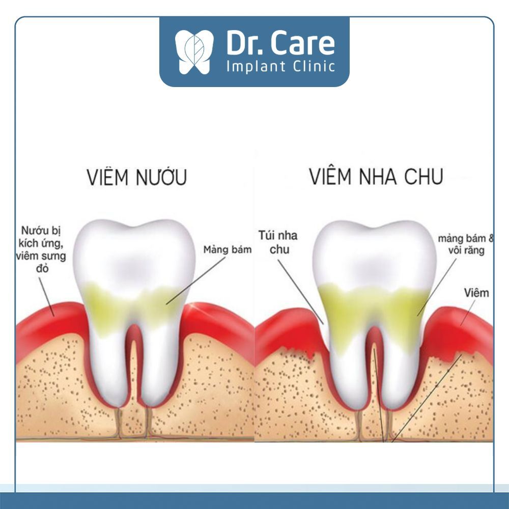 Viêm nha chu sẽ có biểu hiện phức tạp hơn viêm nướu là các tổ chức xung quanh răng viêm nhiễm nặng hơn