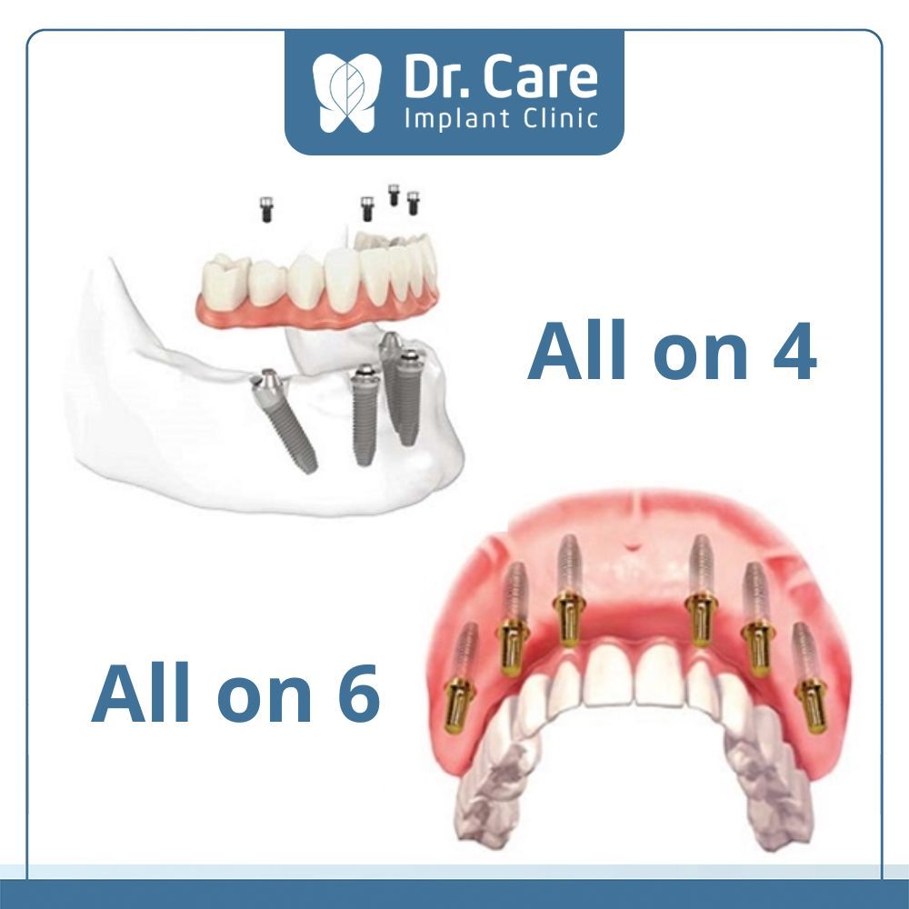 Sự khác biệt chính giữa trồng răng Implant All on 6 và All on 4 là số lượng Implant được cấy ghép