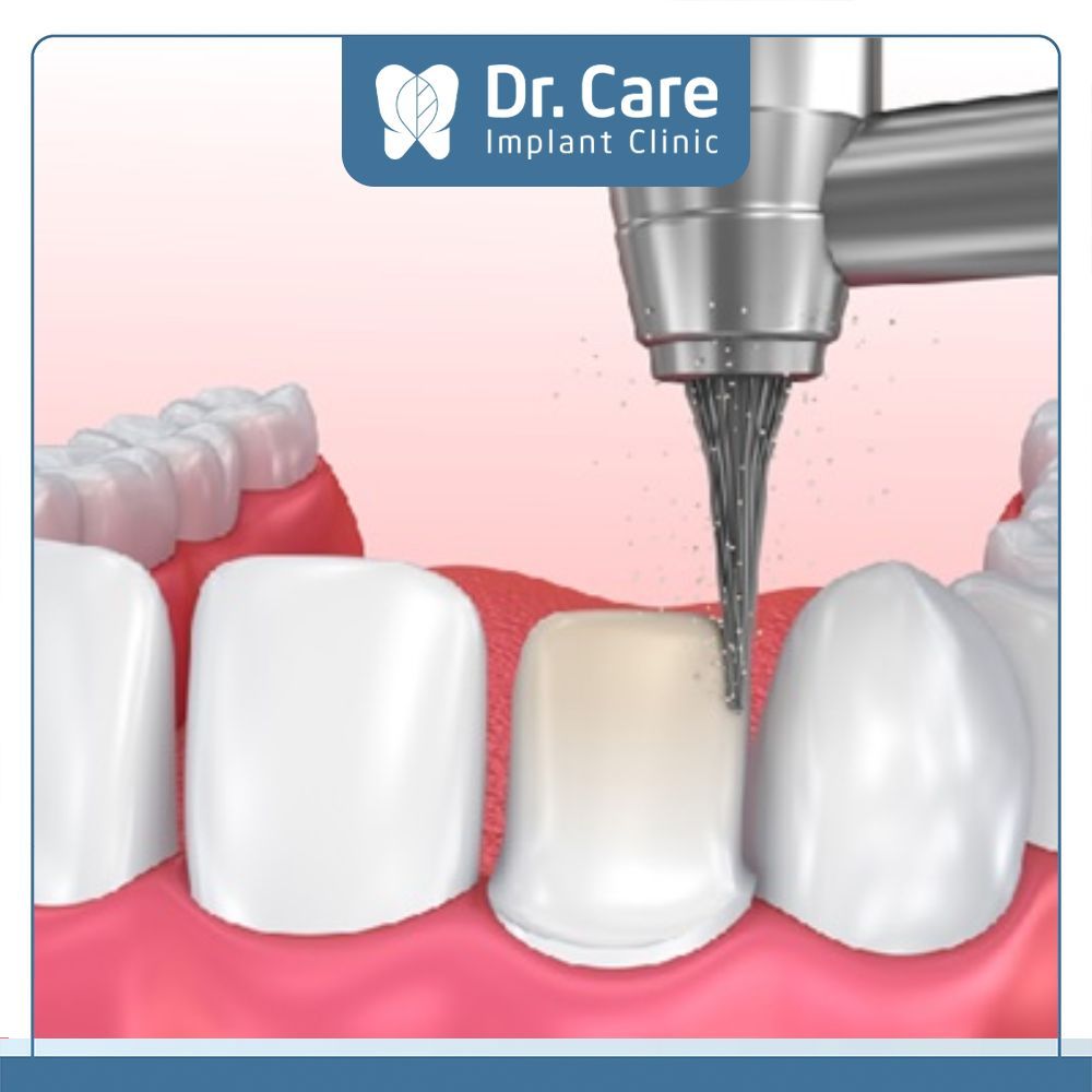 Thực hiện mài cùi răng và lấy dấu mẫu hàm để tạo mão răng sứ phù hợp