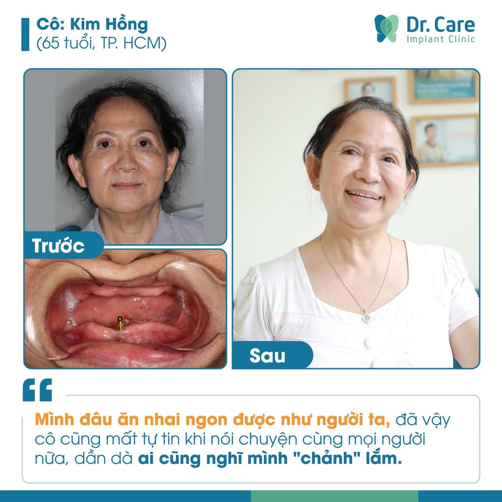 Đã có ai từng trồng răng toàn hàm tại Dr. Care chưa?