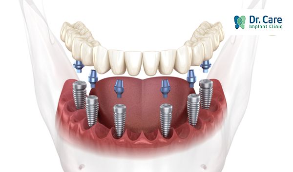 Cấy ghép Implant all on 6 ở đâu tốt tại tphcm