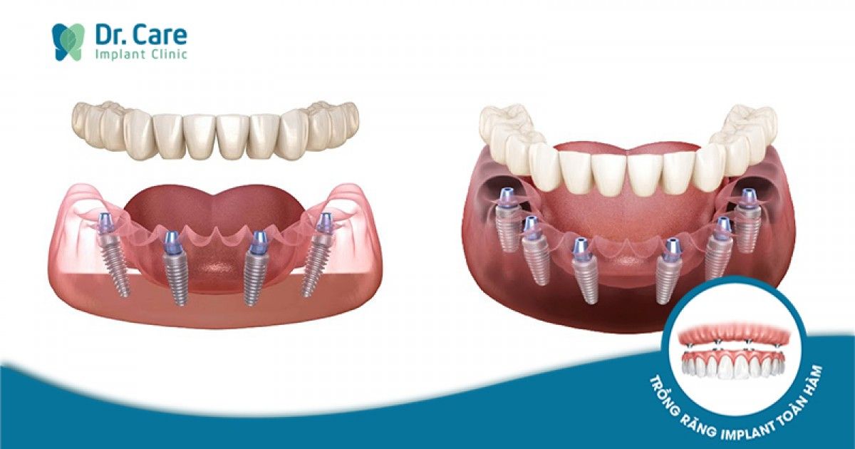 Dịch vụ trồng răng Implant toàn hàm ở đâu tốt tại tphcm