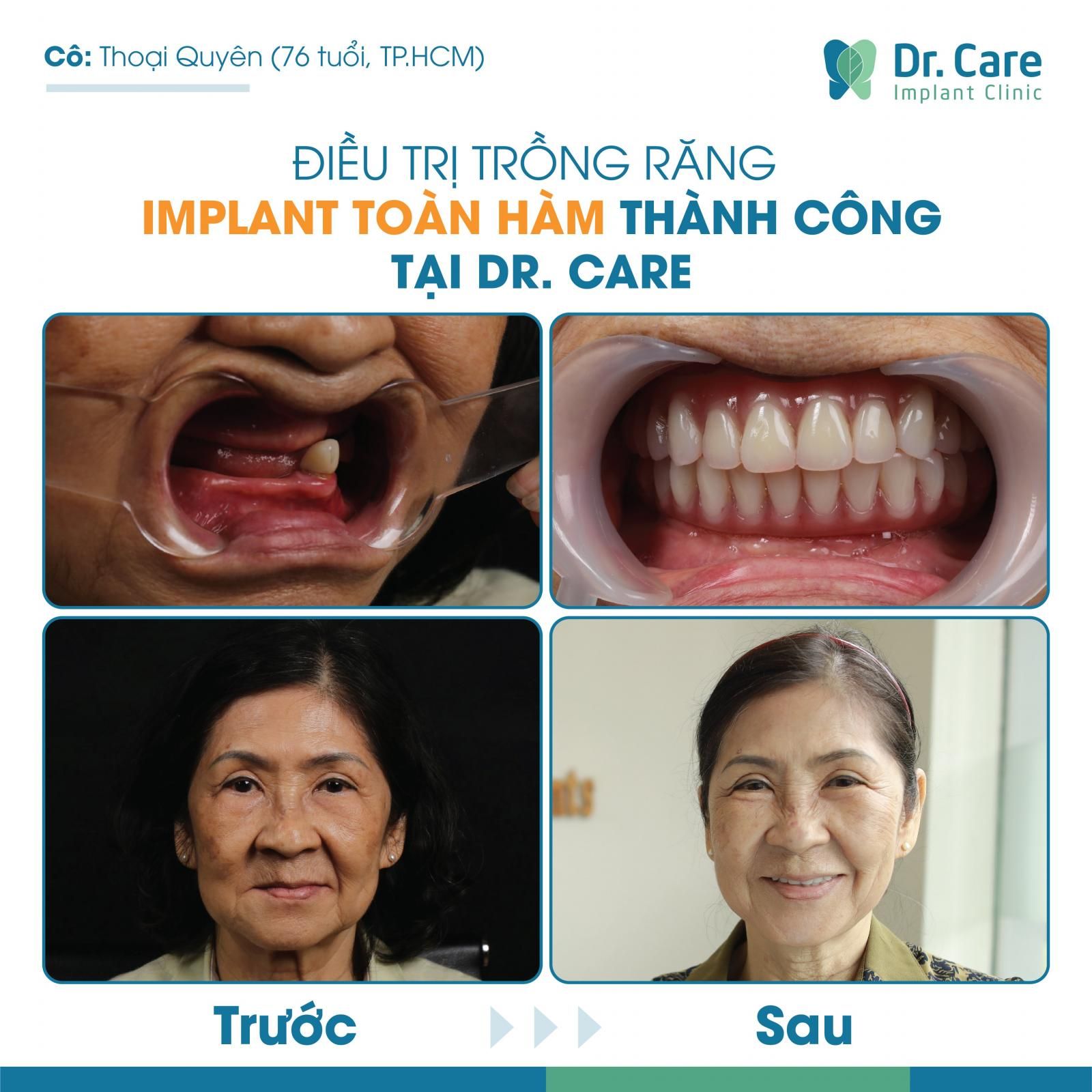 Cấy ghép Implant all on 4 ở đâu tốt tại tphcm