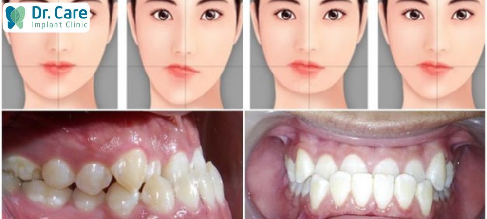 Mặt lệch bên phải do di truyền, thừa hưởng đặc điểm từ bố mẹ từ khi sinh ra