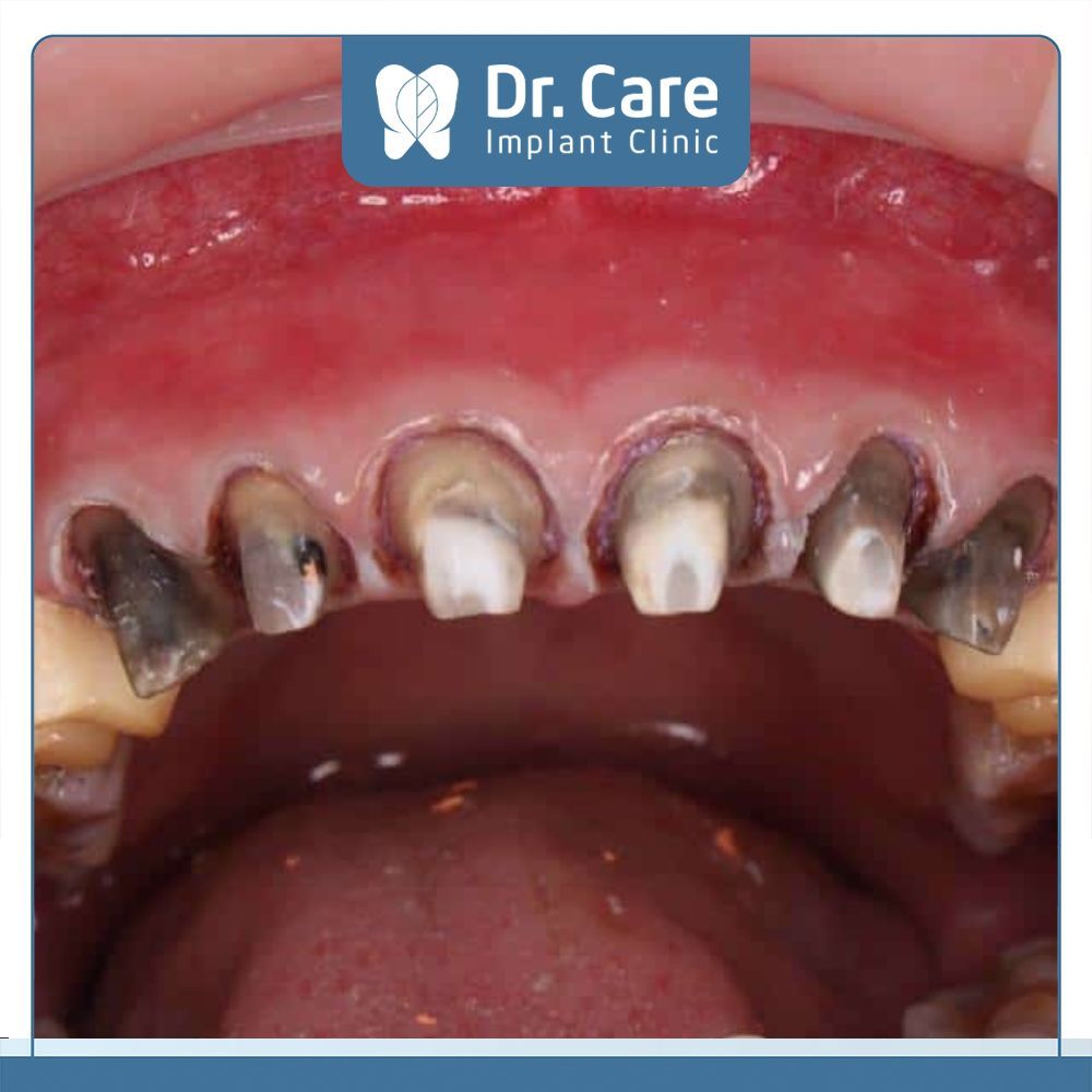 Bọc răng sứ giá rẻ không đảm bảo được chất lượng vì Nha khoa sử dụng các dòng răng sứ giá rẻ, trình độ chuyên môn của Bác sĩ còn kém