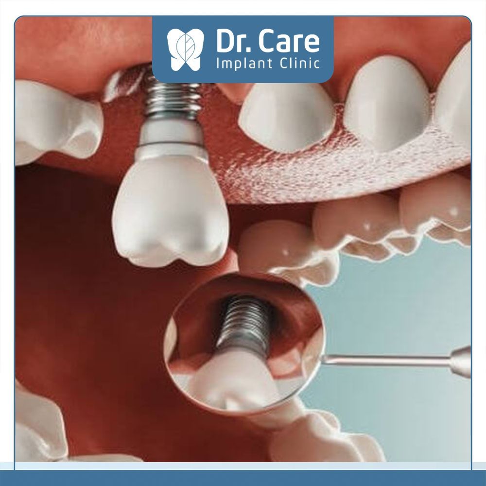 Cô Chú, Anh Chị nên chọn hình thức trả góp thay vì trồng răng Implant giá rẻ