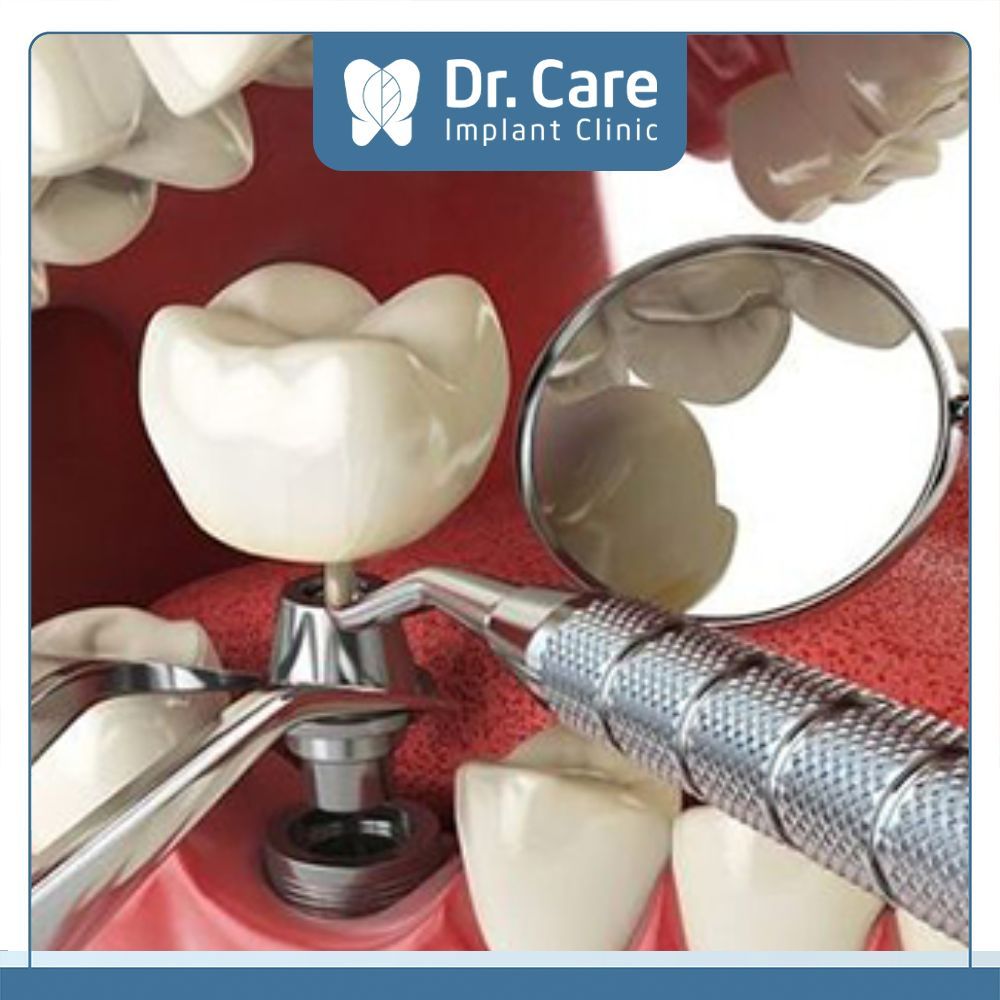  Bác sĩ sẽ gắn mão răng sứ trên trụ Implant thông qua Abutment và bước này Cô Chú, Anh Chị sẽ trải nghiệm độ thoải mái khi sử dụng thông qua việc ăn nhai