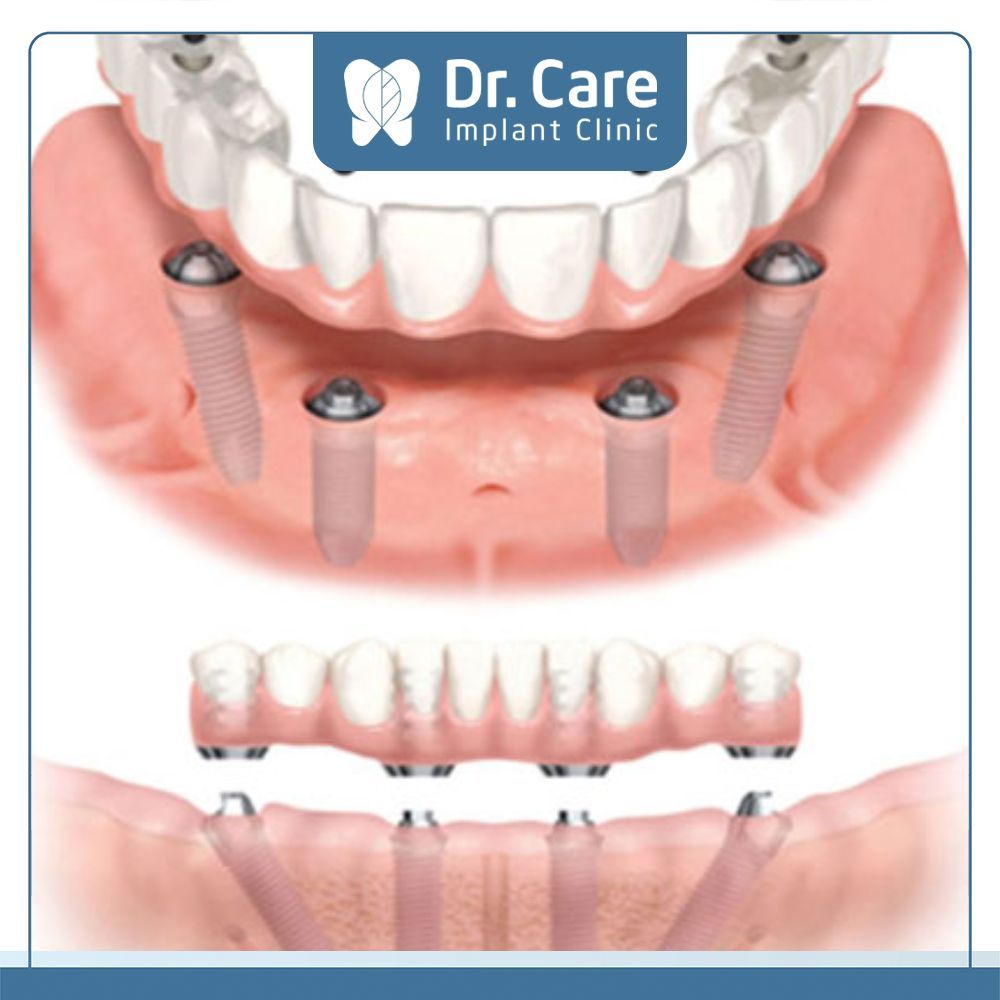 Chi phí hàm phủ trên Implant có mức giá thực tế sẽ có sự chênh lệch tùy thuộc vào loại mão sứ, khớp nối mà Cô Chú, Anh Chị lựa chọn