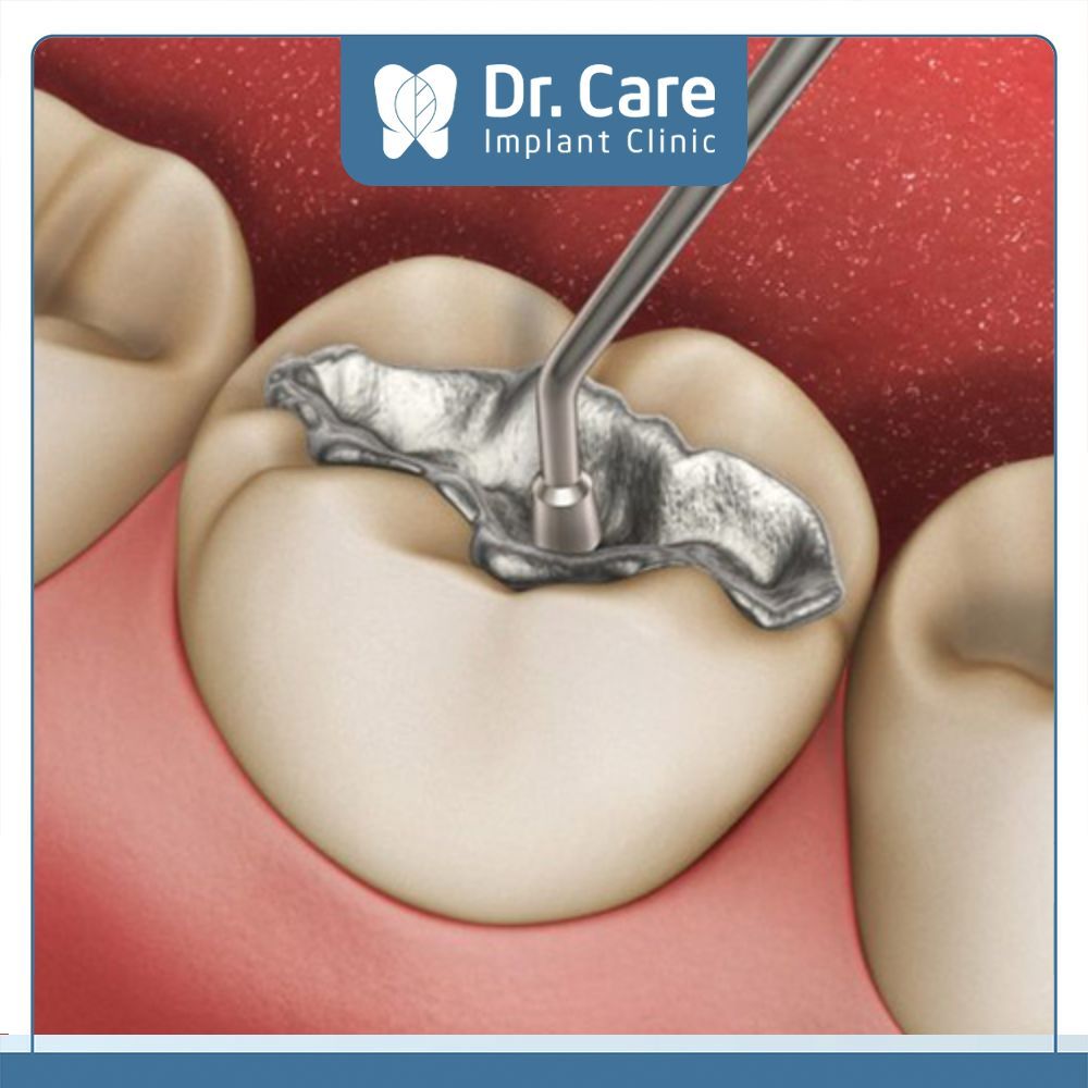 Vật liệu trám răng Amalgam truyền thống, được tạo ra theo một tỷ lệ nhất định từ hợp kim thiếc, thủy ngân, đồng, bạc