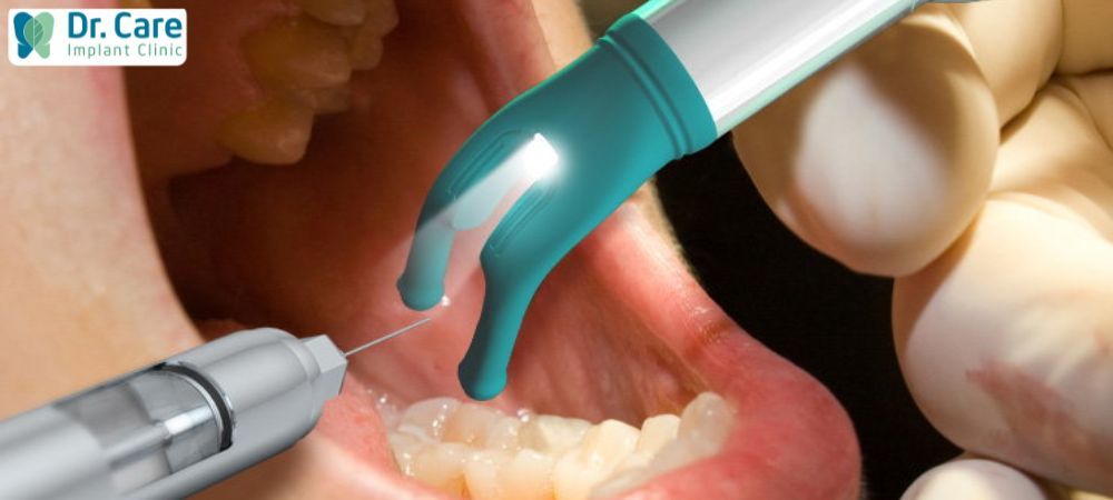 Gây tê trong kỹ thuật cấy ghép Implant là phương pháp vô cảm, ức chế cảm giác đau đớn