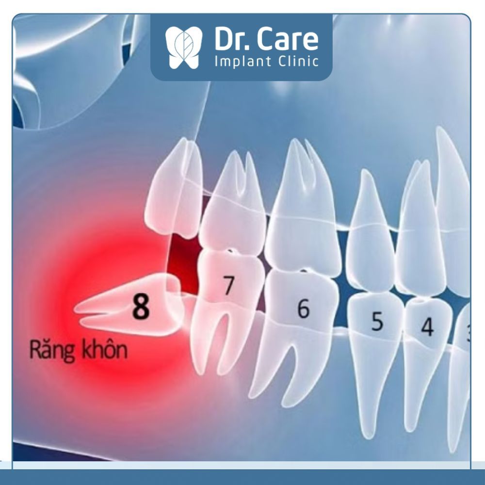  Răng khôn là răng hàm lớn thứ 3 mọc ở vị trí trong cùng và thường xuyên mọc từ 17 - 25 tuổi