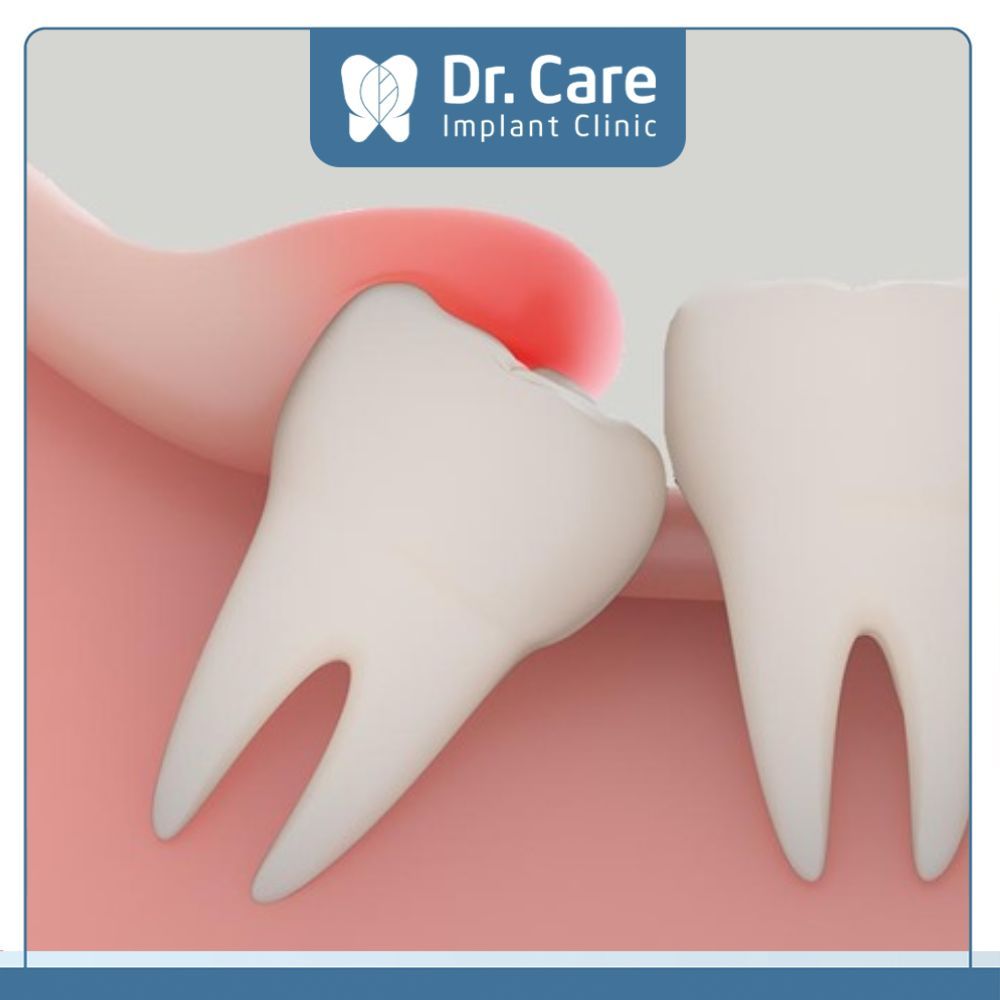 Trường hợp răng mọc lệch ra má hay đâm sang răng số 7 thì cần nhổ bỏ 