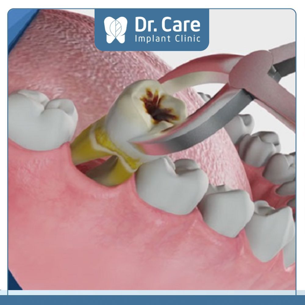 Nhổ răng khôn sức khỏe không đảm bảo an toàn cho sức khỏe của Cô Chú, Anh Chị 