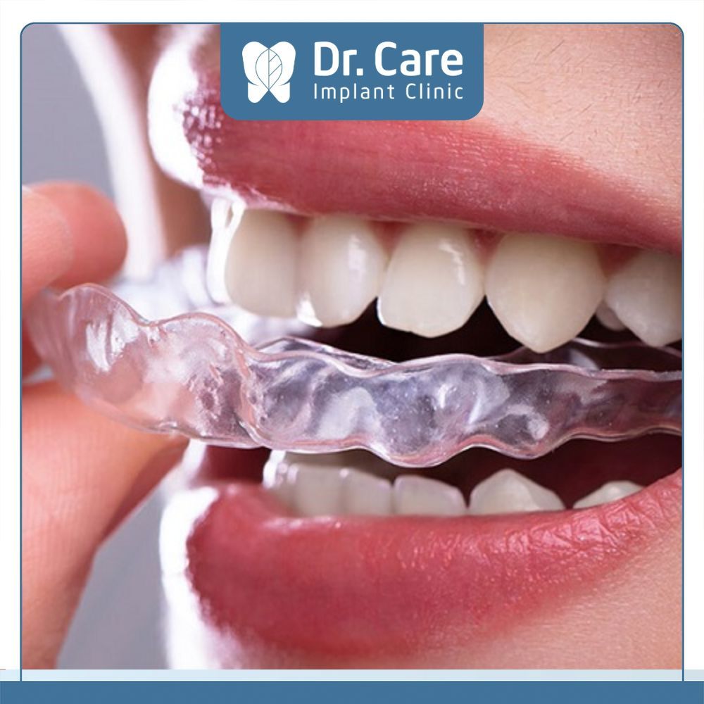 Niềng răng trong suốt Invisalign là phương pháp sử dụng các khay trong suốt bằng nhựa dẻo