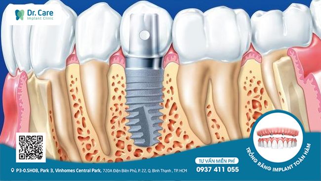 Trồng răng Implant khi vừa mất răng 