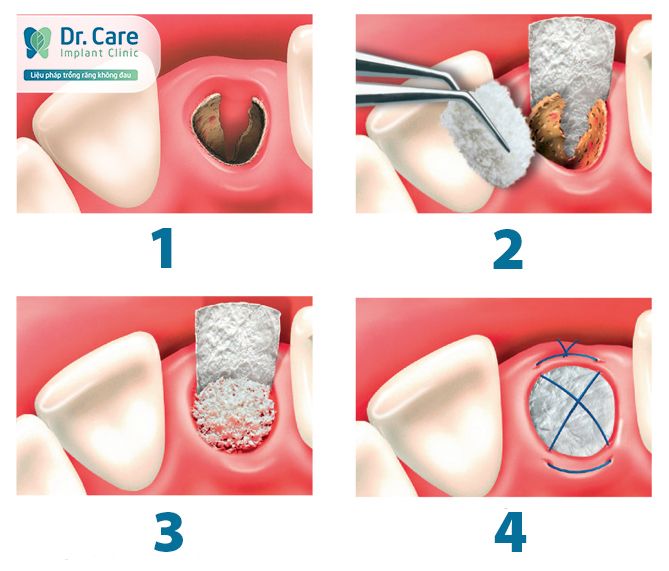 Giải pháp điều trị tình trạng tiêu xương hàm