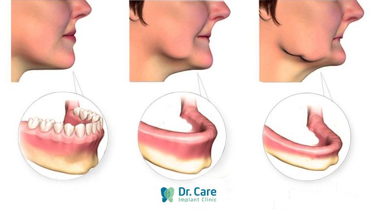 Bị móm sau khi mất răng do tiêu xương