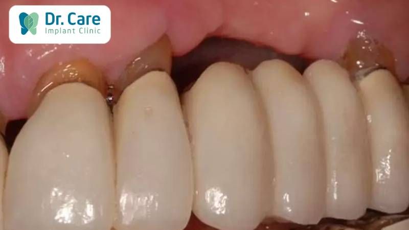 Tiêu xương sau khi sử dụng cầu răng sứ