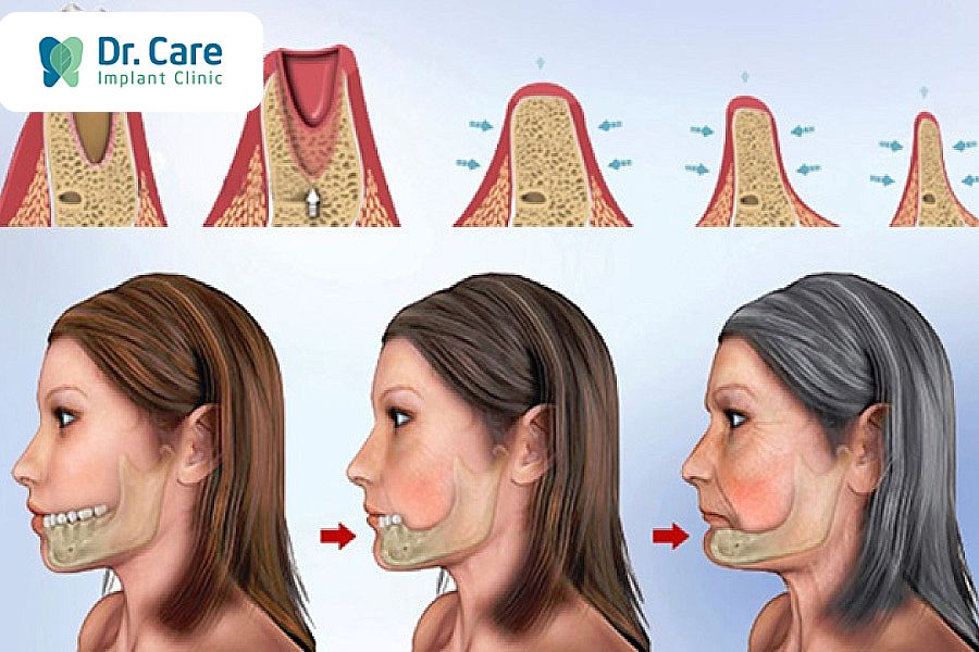 Tiêu xương răng ảnh hưởng đến khuôn mặt 
