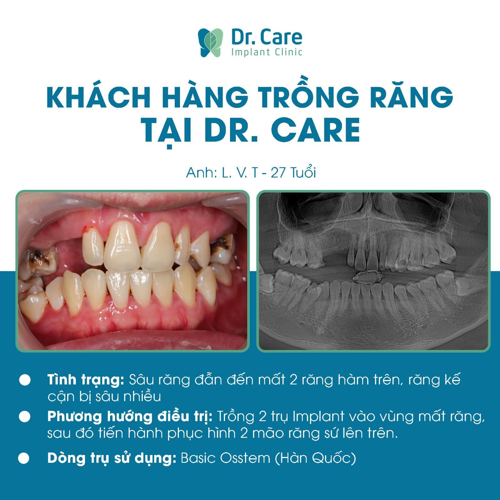 Bị tiêu xương răng có trồng Implant được không?