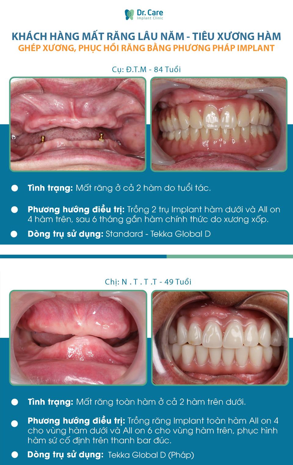 Điều trị tiêu xương răng bằng cấy ghép Implant