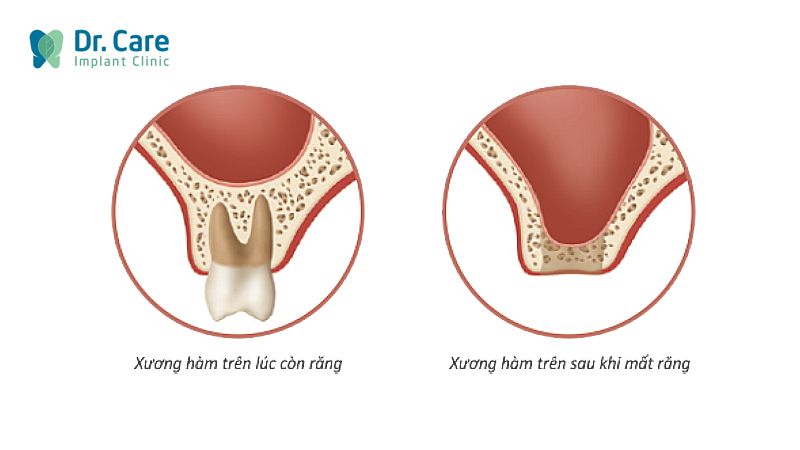 Tiêu xương sau mất răng và viêm nhiễm xung quanh