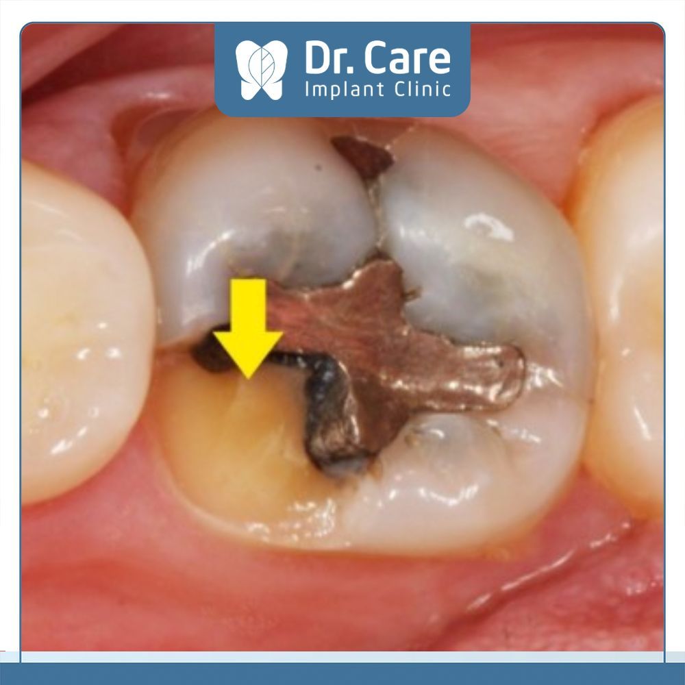 Miếng trám bị lỏng hoặc vỡ sẽ gây ra cảm giác ê buốt và đau nhức, khó chịu