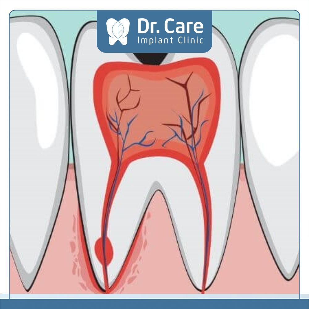 Tủy răng bị viêm sẽ làm các tế bào hoạt động mạnh mẽ và lượng máu lưu thông tăng áp lực bên trong tủy gây đau nhức