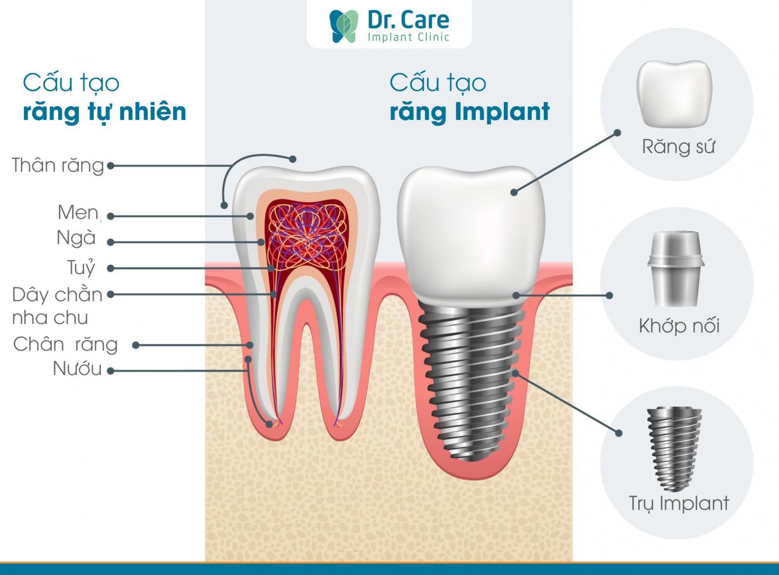 trồng răng implant là gì