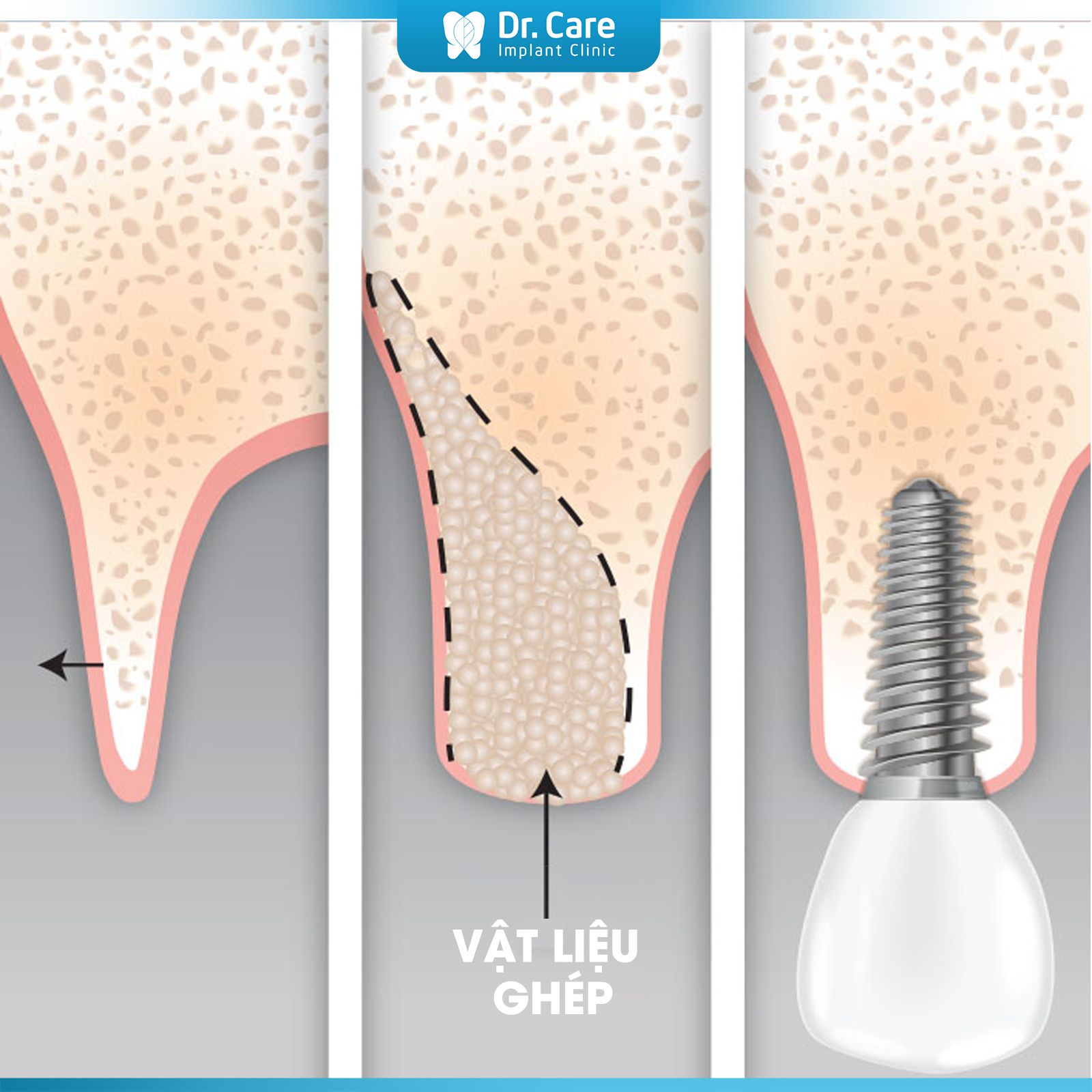 Phẫu thuật tái sinh xương (GBR) là gì?