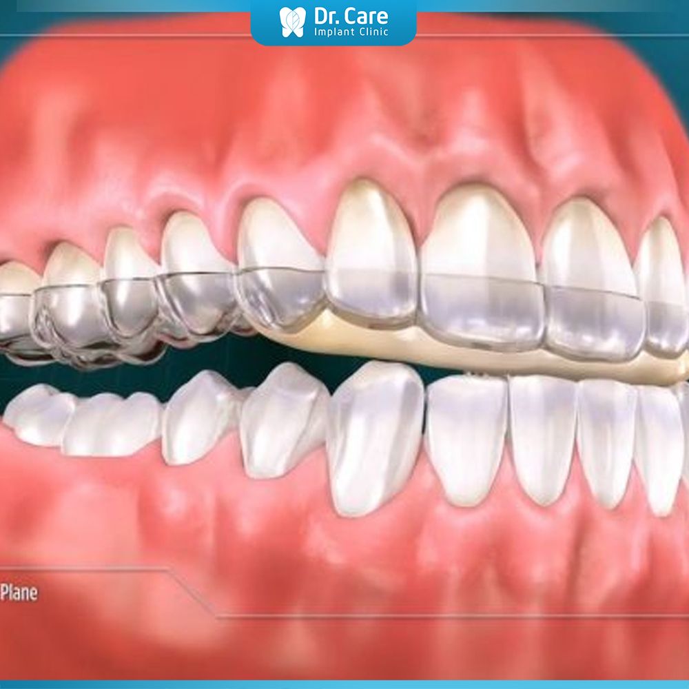 Máng nâng khớp cắn (khí cụ niềng răng)