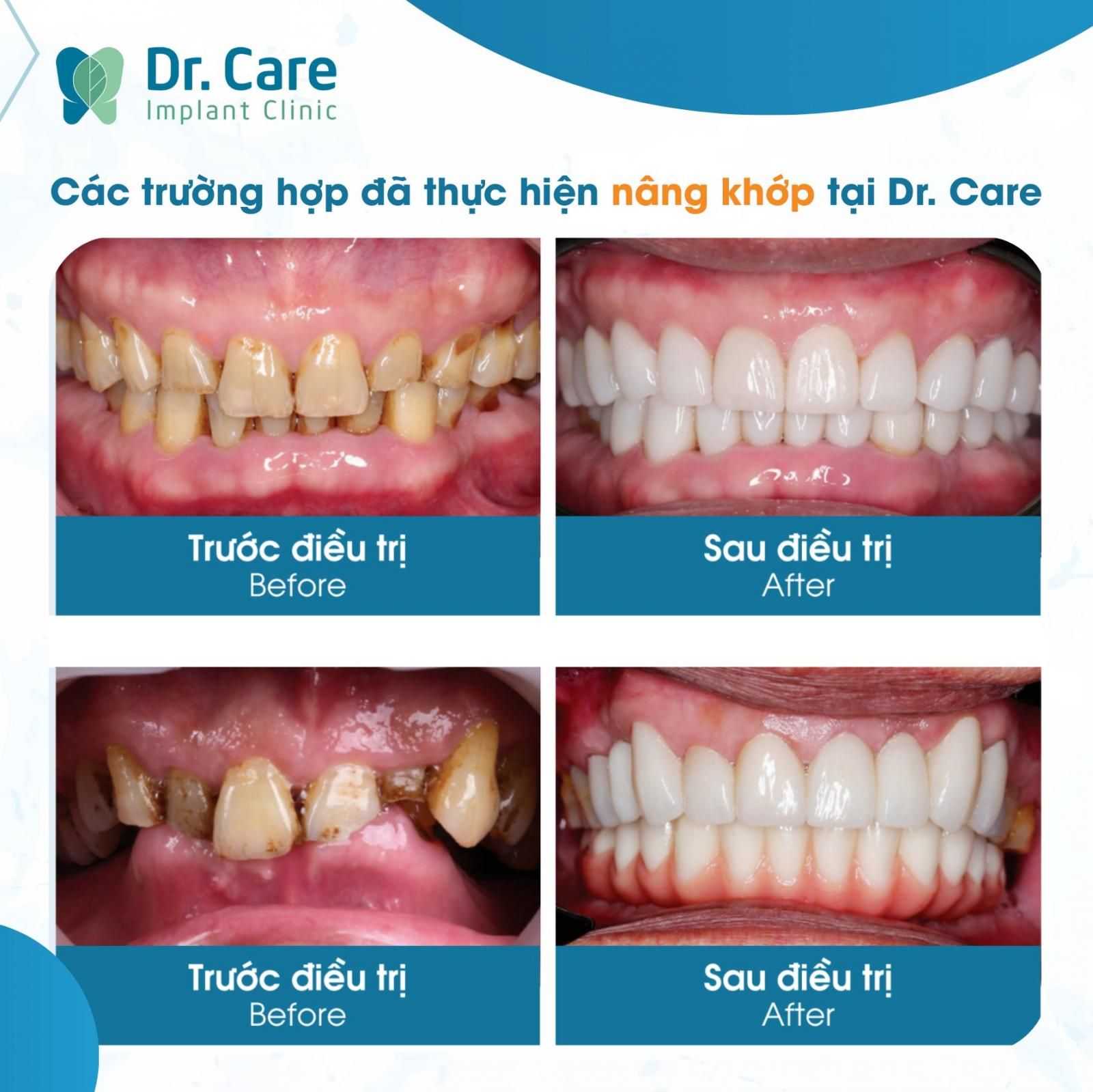 Tác dụng của nâng khớp cắn trong phương pháp trồng răng Implant