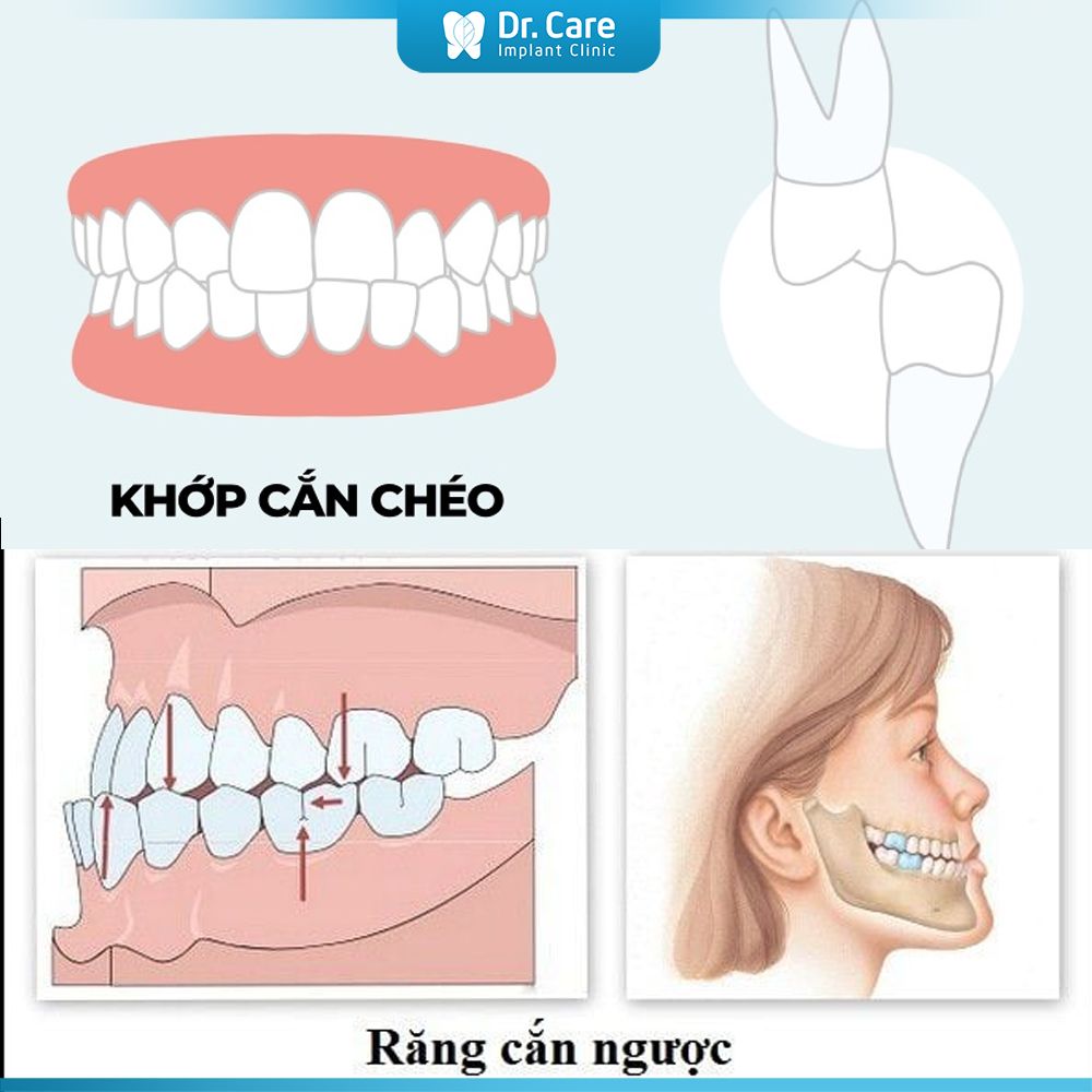 Bệnh nhân bị lệch khớp cắn nghiêm trọng