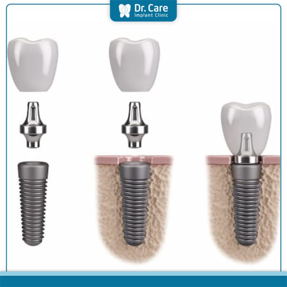 Ưu điểm của trụ Implant Osstem