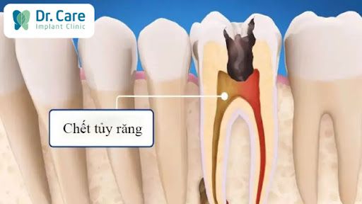 Chết tủy răng là gì?