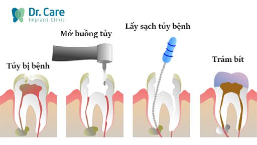 Quy trình điều trị tủy răng